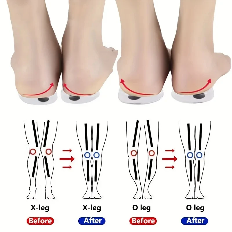 Women Shoes Types - 1Pair Orthopedic Insoles for Feet O/X