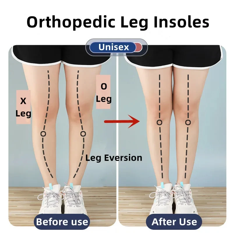 1Pair Orthopedic Insoles for F - огляд і ціна Women Shoes Types